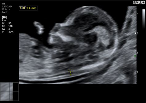 Magzati szív ultrahang