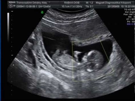 12 hetes ultrahang kép