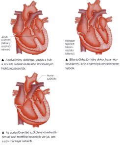 Szív fejlődési rendellenességeinek illusztrációja