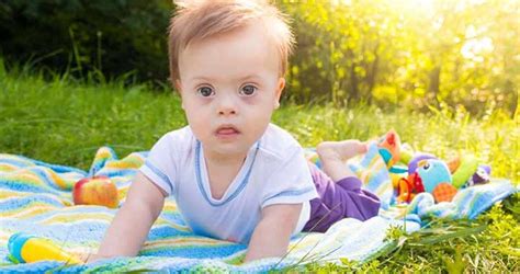 Jellemző arcvonások Down-szindrómás gyermeknél