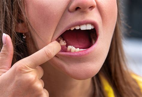 kiesett fog mentése