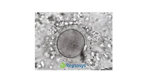 ultrahangos petesejt leszívás