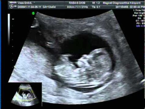 Ultrahangos felvétel a 27 hetes magzatról