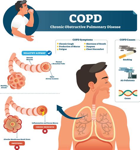 COPD statisztika