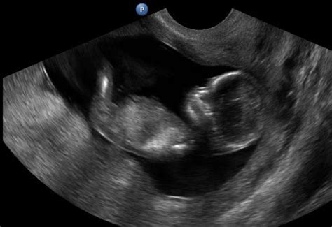 Ultrahangos kép a magzat hasáról