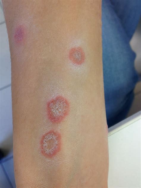 gombás fertőzés tünetei