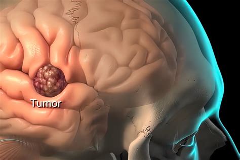 Agyalapi mirigy adenoma