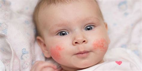 Csecsemő arcán lévő kiütések